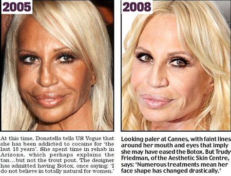 botox versace|donatella Versace human.